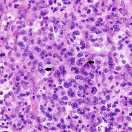 Alk/NPM1;t(2;5) Anaplastic Large Cell Lymphoma (Bone marrow)